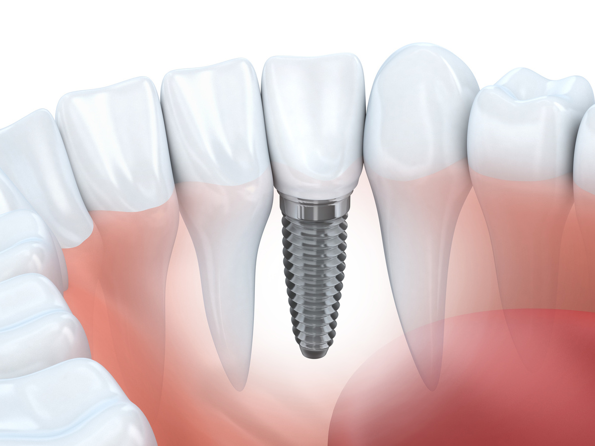General Information on the Causes of Failure of Dental Implantation