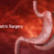 Comparison of Bariatric Surgeries