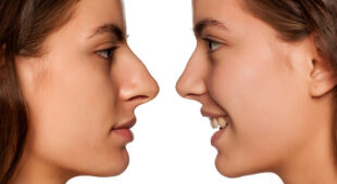 Simple, Effective Nose Surgery