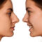 Simple, Effective Nose Surgery